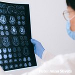 ¿Cómo afecta la COVID-19 al cerebro? según la APA