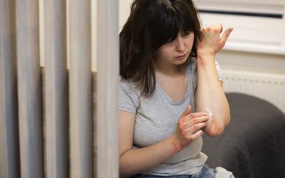 Beneficios de las intervenciones psicológicas a pacientes con psoriasis