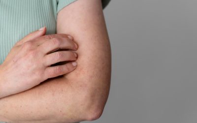 Las enfermedades cutáneas crónicas afectan a la imagen corporal y a la salud mental